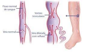 Tratamento de Varizes Brasilia df