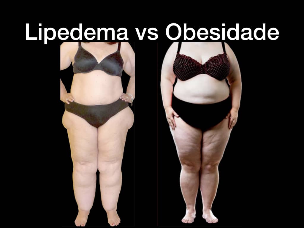 Lipedema e obesidade: entenda a diferença entre as duas condições